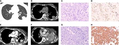Histomorphological transformation from non-small cell lung carcinoma to small cell lung carcinoma after targeted therapy or immunotherapy: A report of two cases